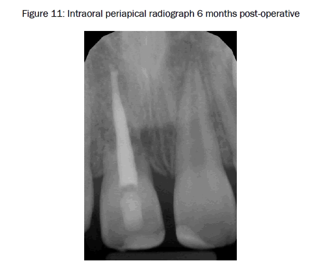 dental-sciences-Intraoral-periapical-radiograph