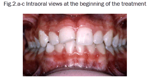 dental-sciences-Intraoral-views-beginning-treatment