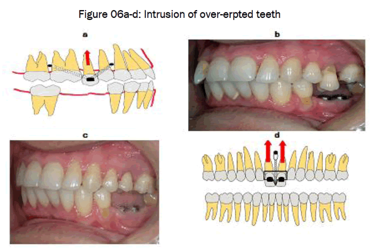 dental-sciences-Intrusion-over-erpted-teeth