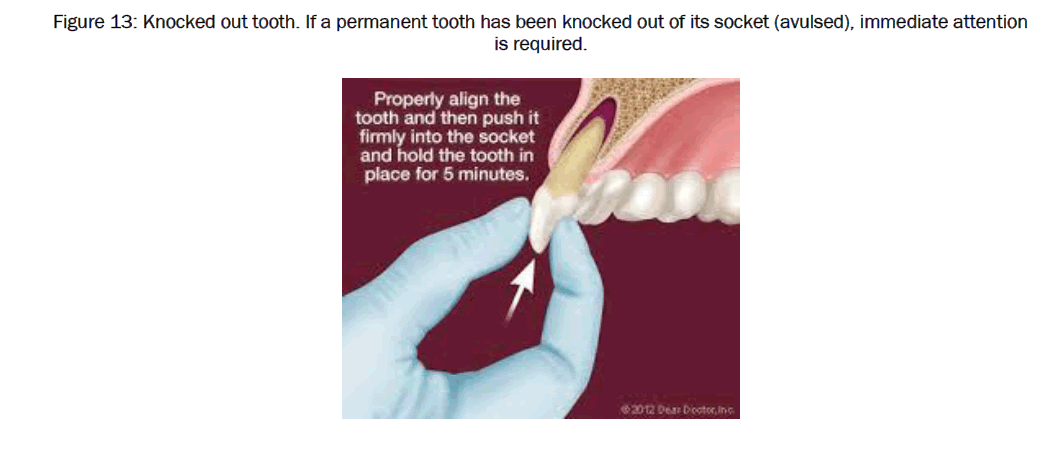 dental-sciences-Knocked-out-tooth