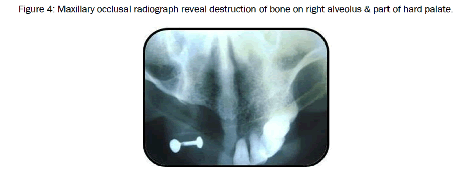 dental-sciences-Maxillary-occlusal-radiograph