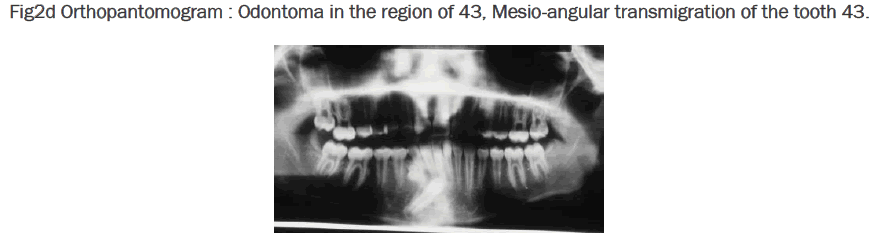 dental-sciences-Mesio-angular-transmigration-tooth