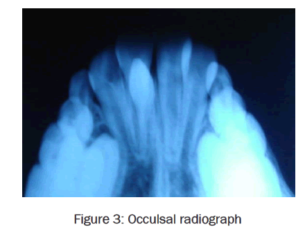 dental-sciences-Occulsal-radiograph