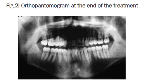 dental-sciences-Orthopantomogram-end-treatment