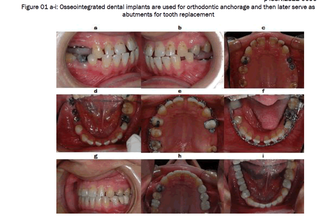 dental-sciences-Osseointegrated-dental-implants