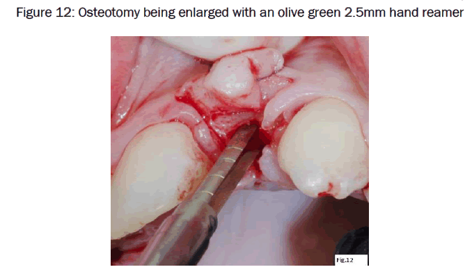 dental-sciences-Osteotomy-being-enlarged