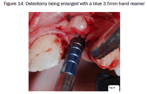 dental-sciences-Osteotomy-being-enlarged