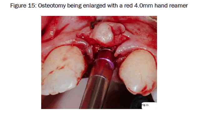 dental-sciences-Osteotomy-being-enlarged