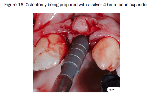 dental-sciences-Osteotomy-being-prepared