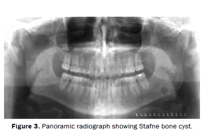 dental-sciences-Panoramic-Panoramic-radiograph-Stafne-bone-cyst