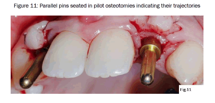 dental-sciences-Parallel-pins-seated
