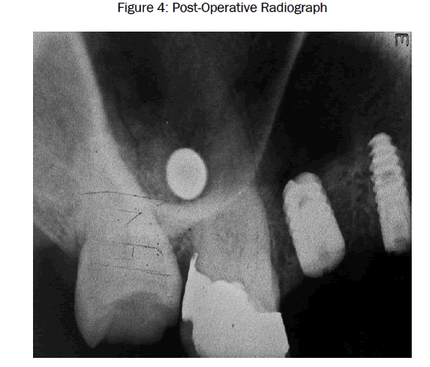 dental-sciences-Post-Operative-Radiograph