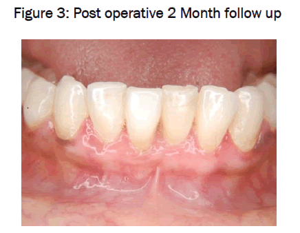 dental-sciences-Post-operative-2-Month-follow-up