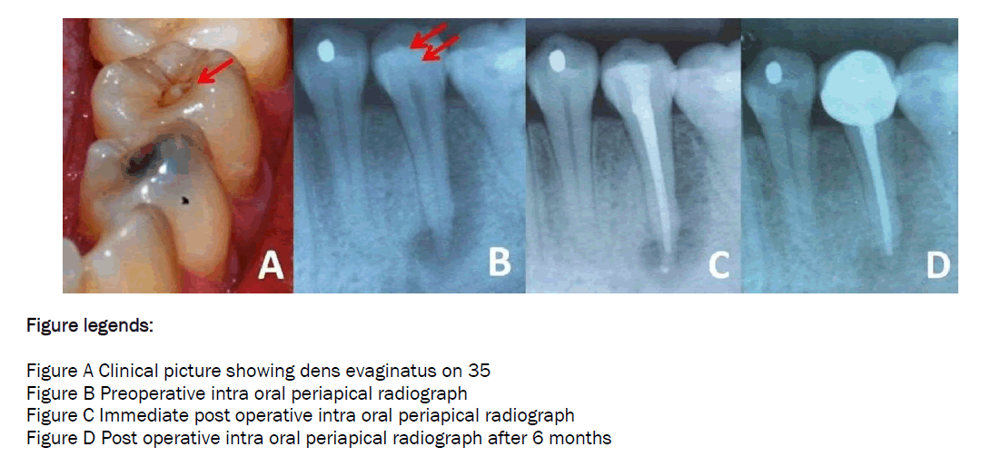 dental-sciences-Post-operative-intra-oral