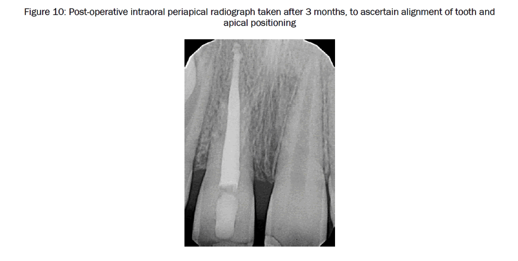 dental-sciences-Post-operative-intraoral