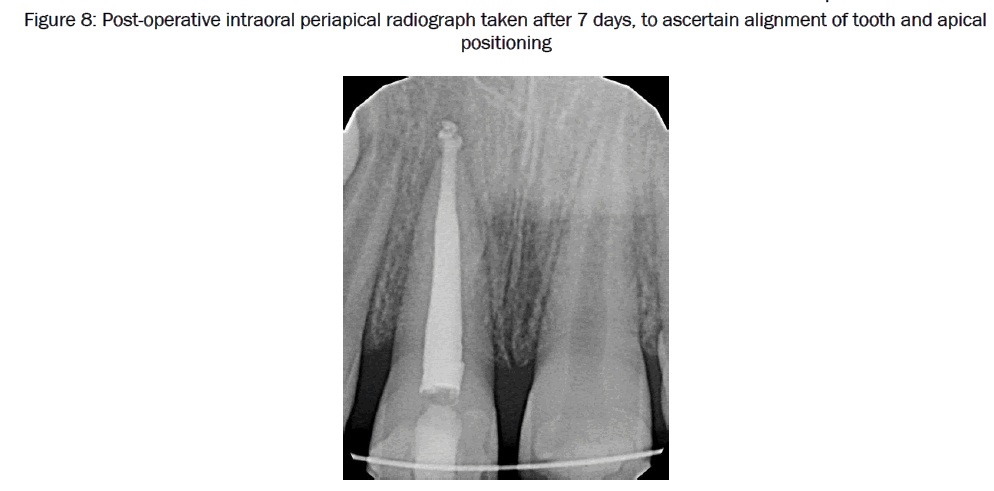 dental-sciences-Post-operative-intraoral-periapical