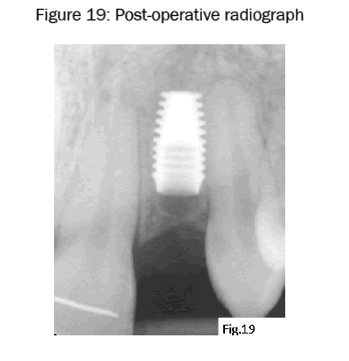 dental-sciences-Post-operative-radiograph