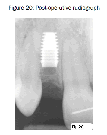 dental-sciences-Post-operative-radiograph