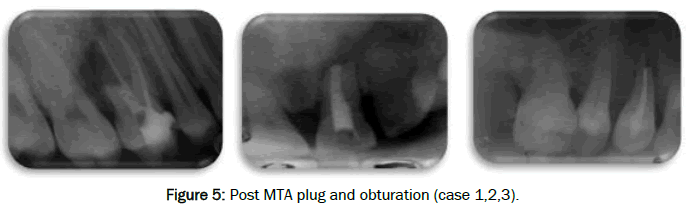 dental-sciences-Post-plug-obturation