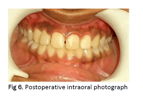 dental-sciences-Postoperative-intraoral-photograph