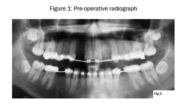dental-sciences-Pre-operative-radiograph
