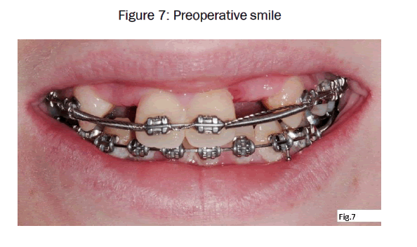dental-sciences-Preoperative-smile
