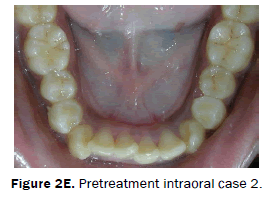 dental-sciences-Pretreatment-intraoral-case