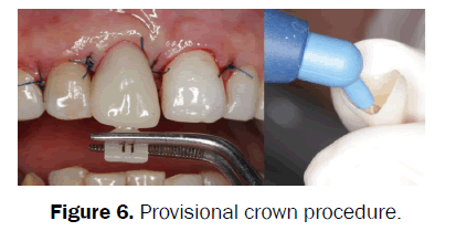 dental-sciences-Provisional-crown-procedure