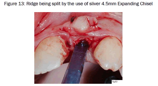 dental-sciences-Ridge-being-split