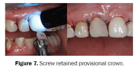 dental-sciences-Screw-retained-provisional