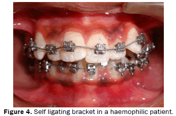 dental-sciences-Self-ligating-bracket