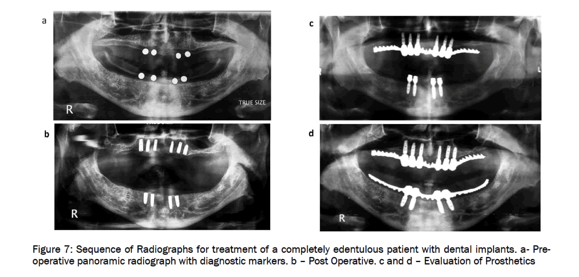 dental-sciences-Sequence-Radiographs-treatment