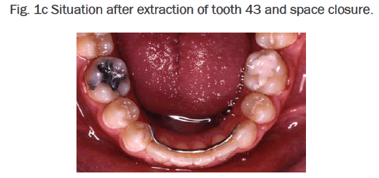 dental-sciences-Situation-after-extraction