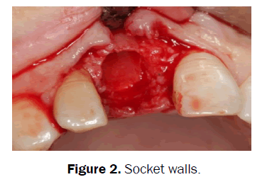 dental-sciences-Socket-walls