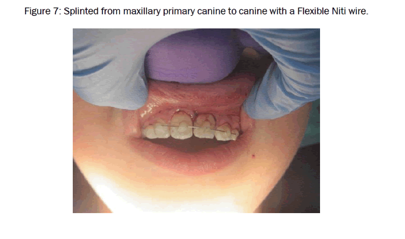 dental-sciences-Splinted-maxillary-primary
