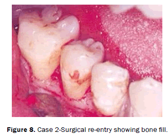 dental-sciences-Surgical-re-entry-bone-fill