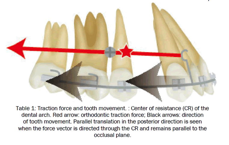 dental-sciences-Traction-force-tooth-movement