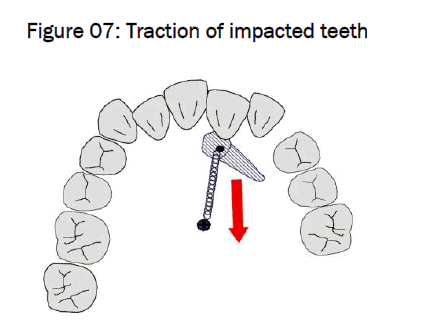 dental-sciences-Traction-impacted-teeth