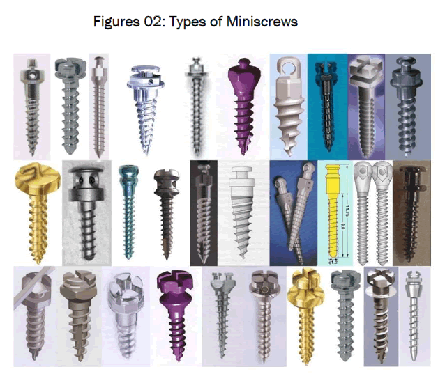 dental-sciences-Types-Miniscrews
