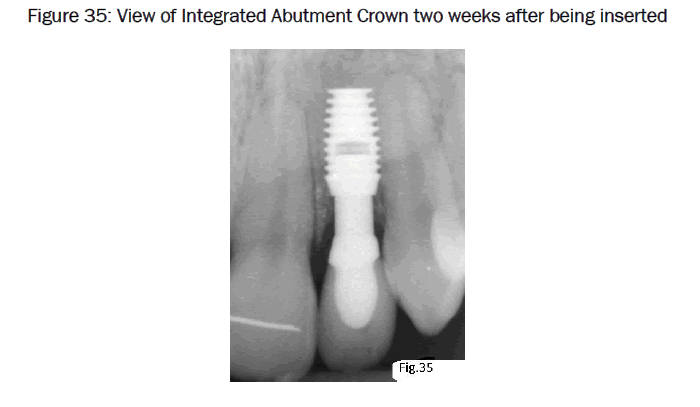 dental-sciences-View-Integrated-Abutment