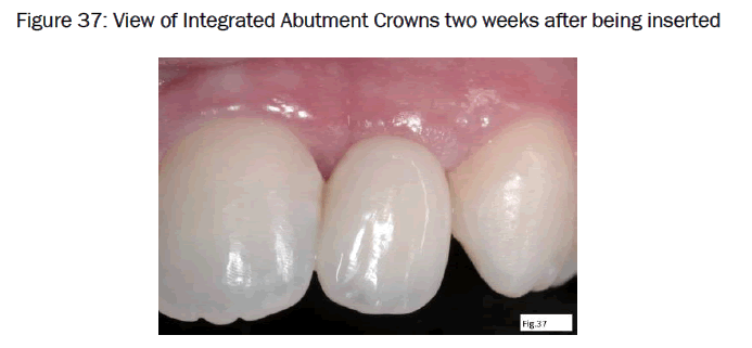 dental-sciences-View-Integrated-Abutment