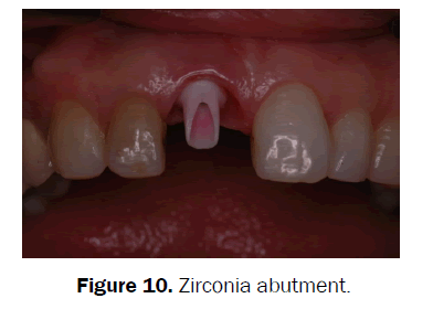 dental-sciences-Zirconia-abutment