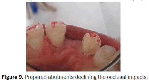 dental-sciences-abutments