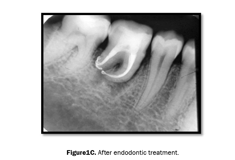 dental-sciences-after-endodontic