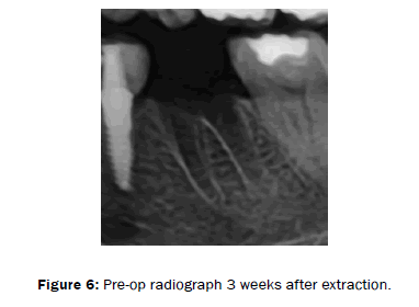 dental-sciences-after-extraction