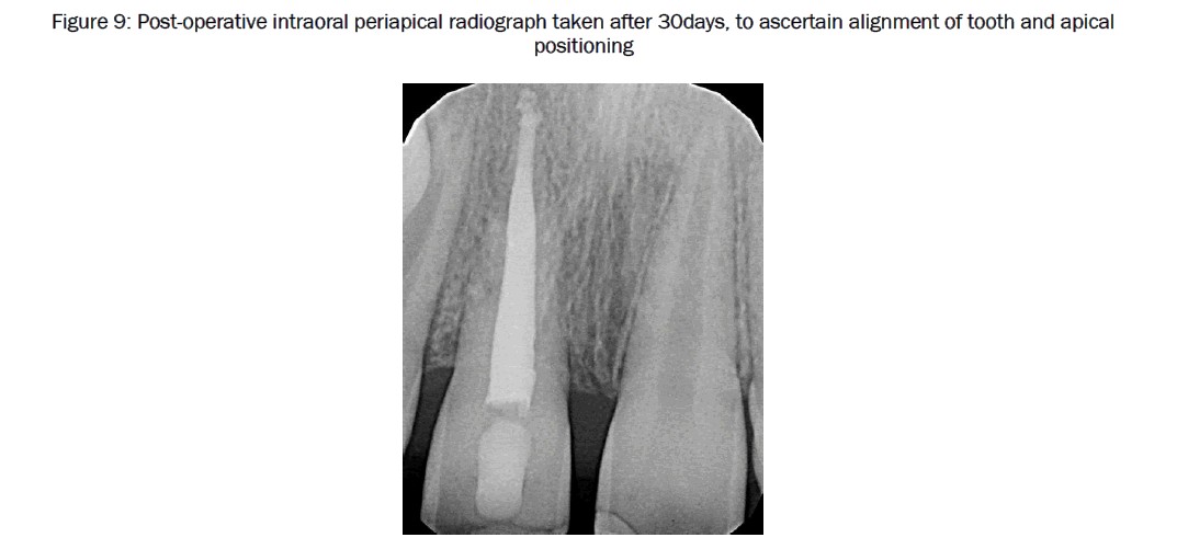 dental-sciences-alignment-tooth-apical