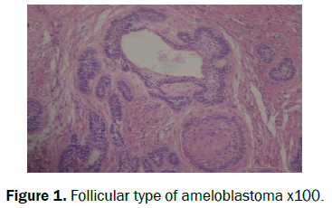 dental-sciences-ameloblastoma