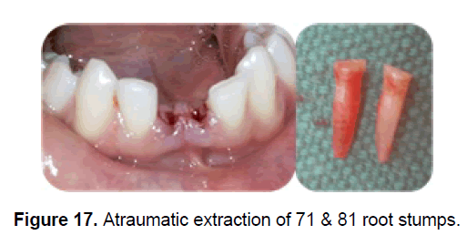 dental-sciences-atraumatic-extraction