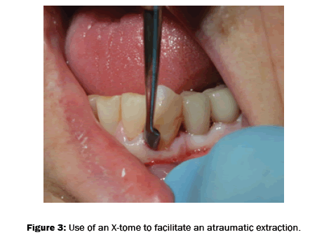 dental-sciences-satraumatic-extraction