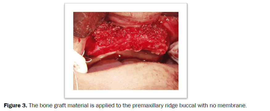 dental-sciences-bone-graft-material